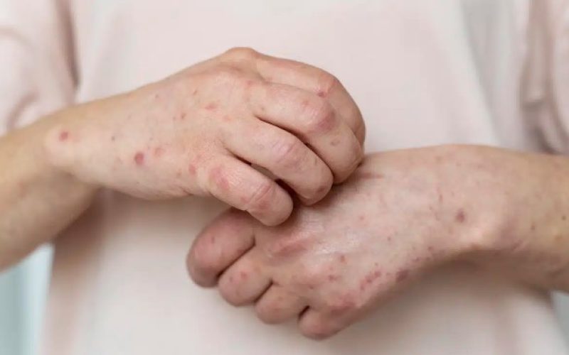 No Dia Mundial do Lúpus, especialista reforça importância de reconhecer os sintomas